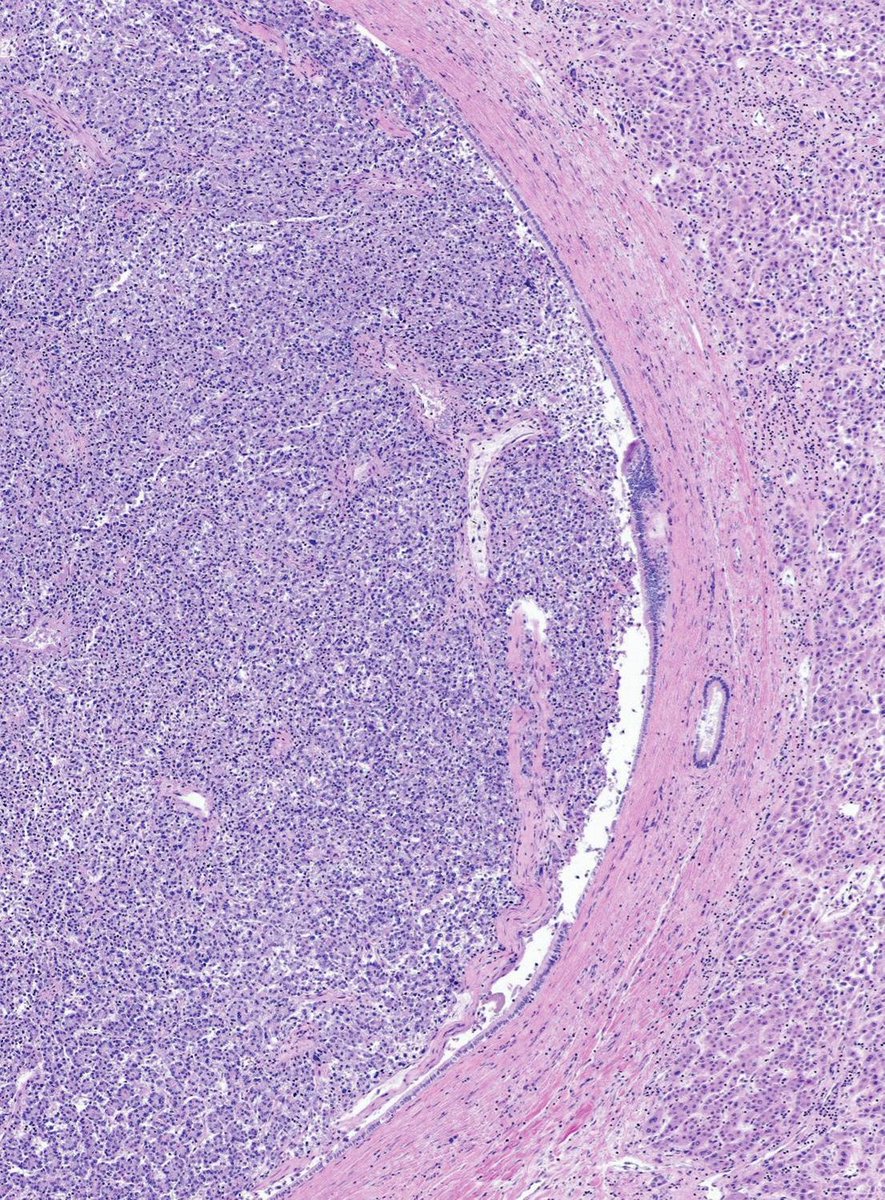 #PathQuiz 🔬

A) Bile duct adenoma
B) Biliary IOPN
C) Biliary ITPN
D) BilIN
#Pathology #GIPath 
<a href="/IARCWHO/">IARC</a> Clue in caption 🧐
