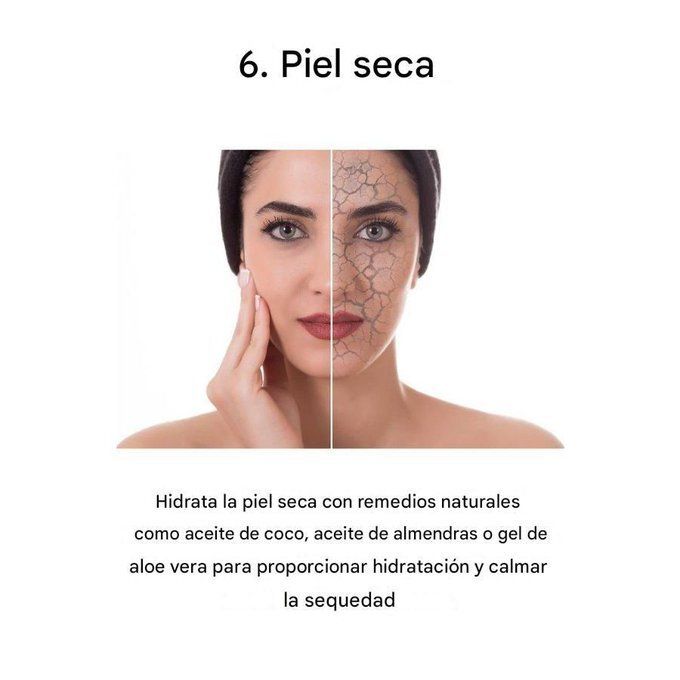 YosuepEstebanX's tweet photo. 6. Piel seca

¿Cara escamosa? ¿Manos agrietadas?

Los humectantes de la naturaleza hacen maravillas:
• Aceite de coco
• Aceite de almendras
• Gel de aloe vera

Aplícalo después de la ducha para retener la hidratación. No necesita químicos. https://t.co/mJ1YcDLSuO