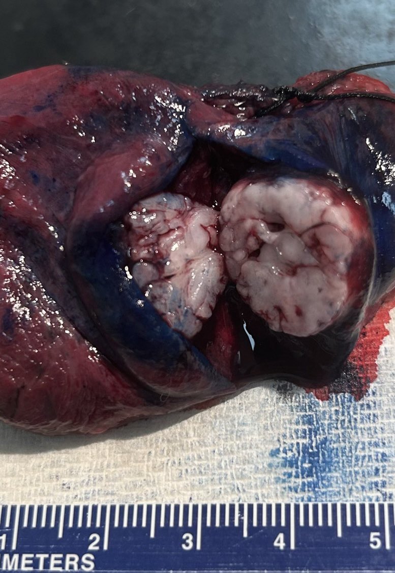 BrownPathology's tweet image. #Pulmpath #Grosspath #Surgpath #Pathresidents #BSTpath

A 60 year old smoker was found to have a 2cm peripheral lesion on a low-dose screening CT.

Gross image below, followed by 2 poll questions and a short discussion.

Go!