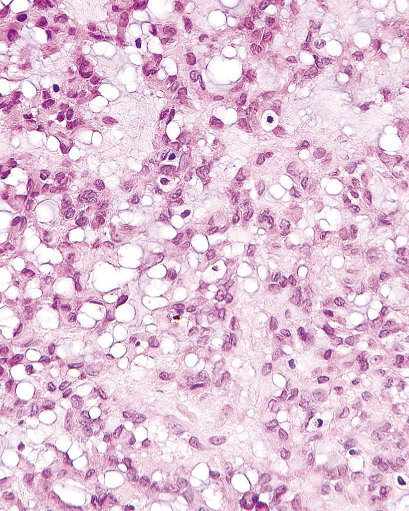 DrCycloPath's tweet photo. #NeuroPah #PathQuiz 🔬🧠
A) Chordoma
B) Papillary craniopharyngioma
C) Schwannoma
D) Chordoid glioma

#Pathology 
Clue in caption 🧐 https://t.co/XsesJnqyrc