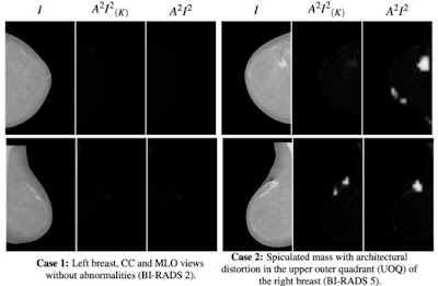 Radiology_AI's tweet photo. Visualizing Radiologic Connections: An Explainable Coarse-to-Fine Foundation Model with Multiview Mammograms and Associated Reports https://t.co/C3TsznOtJk #breast #MachineLearning #FoundationModel https://t.co/I4aj9T1ZoG