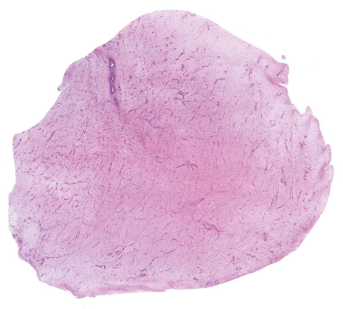 DrCycloPath's tweet photo. #PathQuiz 🔬
A) Angiomyofibroblastoma
B) Cellular angiofibroma
C) Fibroepithelial stromal polyp
D) Aggressive angiomyxoma

#Pathology #GYNPath 
Clue in caption 🧐
@IARCWHO https://t.co/9y0557NHMY