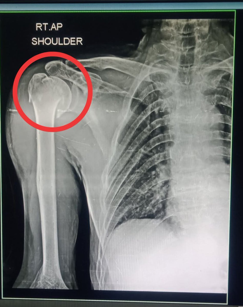albertoortegana's tweet image. A Patient is  50yrs
H/O RTA 
What is Your Diagnosis 
#xray #fracture #hospital #doctor #healthcare 
@dr_manish_ydv @Dr_Shiv_kumar_ @DrMedica_13 @drobiy12 @hemo_shk @shakilED