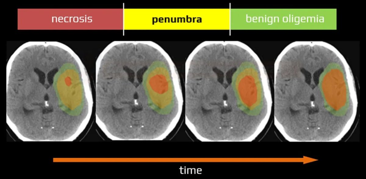 MDtheDO's tweet photo. Prehospital Case Review - Case 2: Stroke with Hemiplegia and Aphasia.

65yo male. Gaze deviation. Aphasia. 78 min to reperfusion. NIHSS 0 at discharge.

Full case breakdown from the field to thrombectomy. Link below.

#EMS #Paramedic #EmergencyMedicine #Neurology #Stroke #FOAMEd https://t.co/x2BjZCozxb