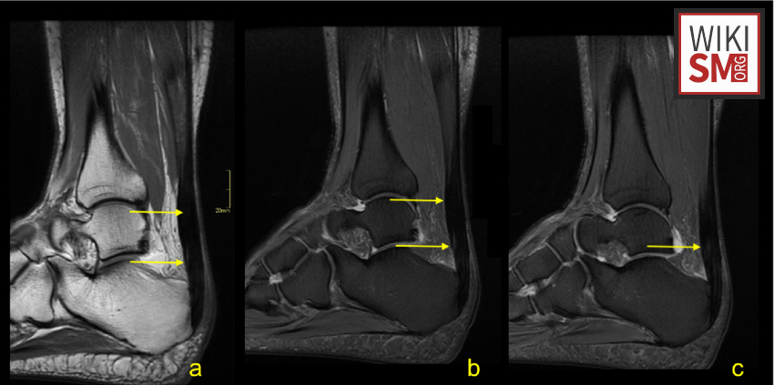 SportsMedReview's tweet photo. Dr Kiel provides a quick review of Achilles tendonitis which causes posterior heel pain, stiffness, and swelling, often from overuse. Early treatment and rehab are key for recovery.

Read: https://t.co/mlIlPYFWK1

#SportsMedicine #Orthopedics #PhysicalTherapy #AthleticTraining #Rehab #InjuryPrevention #Physio #SportsInjury #SportsRehab #PhysioTherapy #Meded #ATC #FOAMed