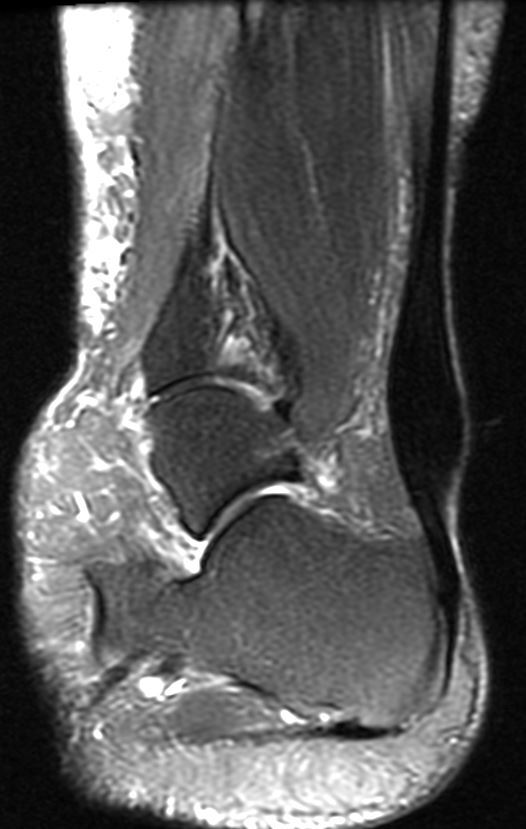 SportsMedReview's tweet photo. Dr Kiel provides a quick review of Achilles tendonitis which causes posterior heel pain, stiffness, and swelling, often from overuse. Early treatment and rehab are key for recovery.

Read: https://t.co/mlIlPYFWK1

#SportsMedicine #Orthopedics #PhysicalTherapy #AthleticTraining #Rehab #InjuryPrevention #Physio #SportsInjury #SportsRehab #PhysioTherapy #Meded #ATC #FOAMed