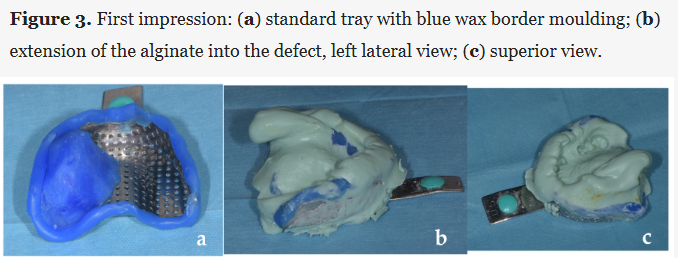 New in Prosthesis: "Surgical Procedures to Enhance Prosthetic Prognosis in the Rehabilitation of a Maxillectomy Defect Due to Sinonasal Carcinoma: A Case Report"

by Crupi et al.

🔓 #Open_Access, free to read at: brnw.ch/21x19KQ

#Prosthetics #MaxillofacialProsthetics