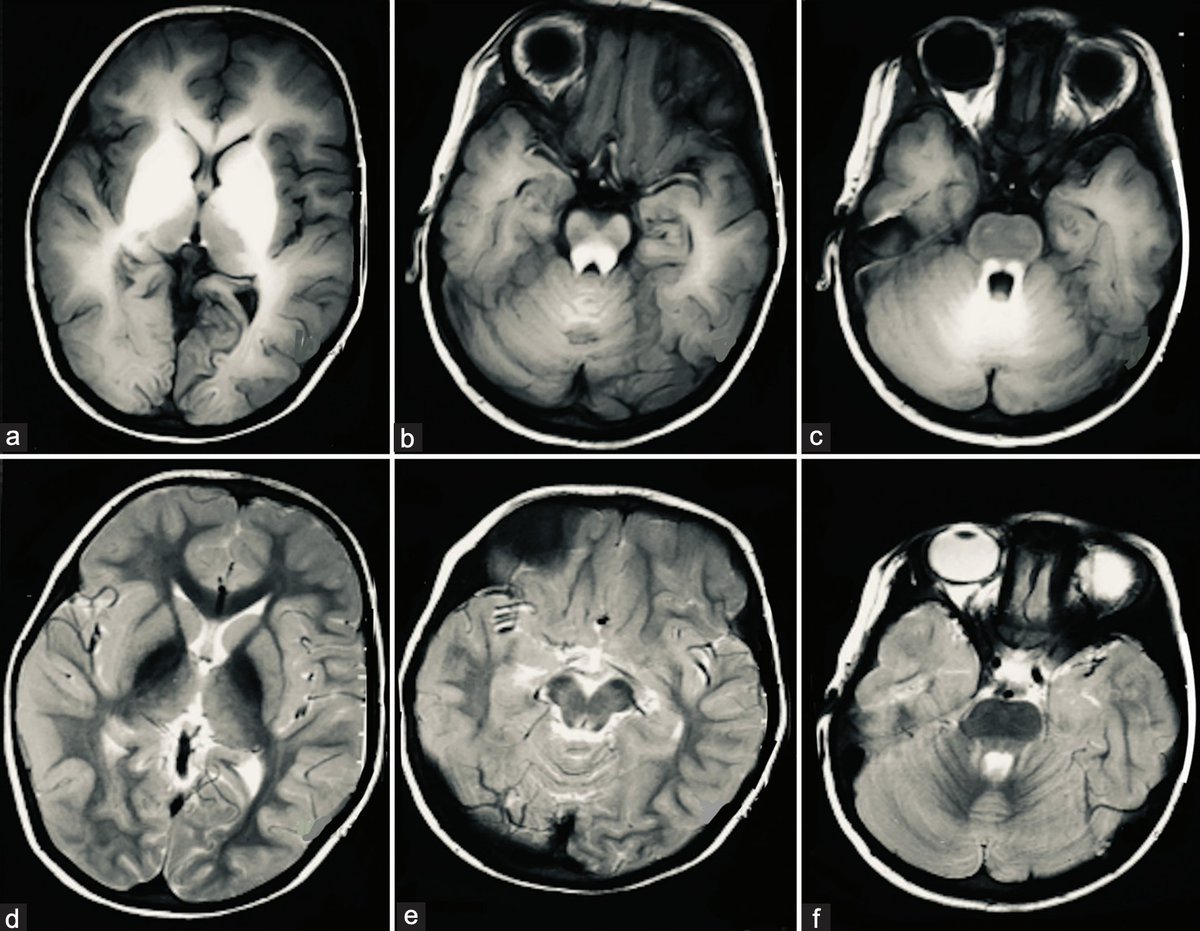 Annals of Indian Academy of Neurology tweet media