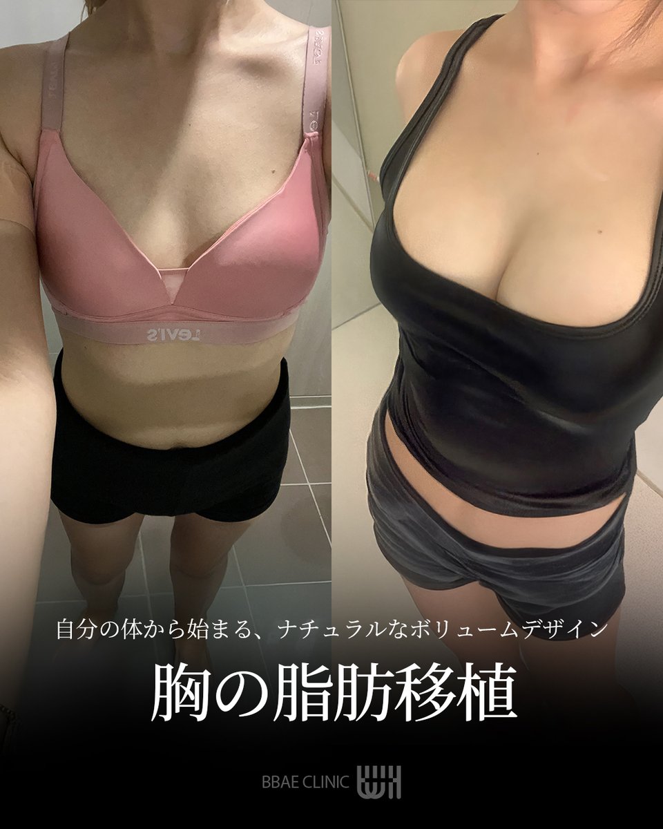 BBAE CLINIC | ポムナゲ・ペー ♥ 韓国脂肪吸引 tweet media