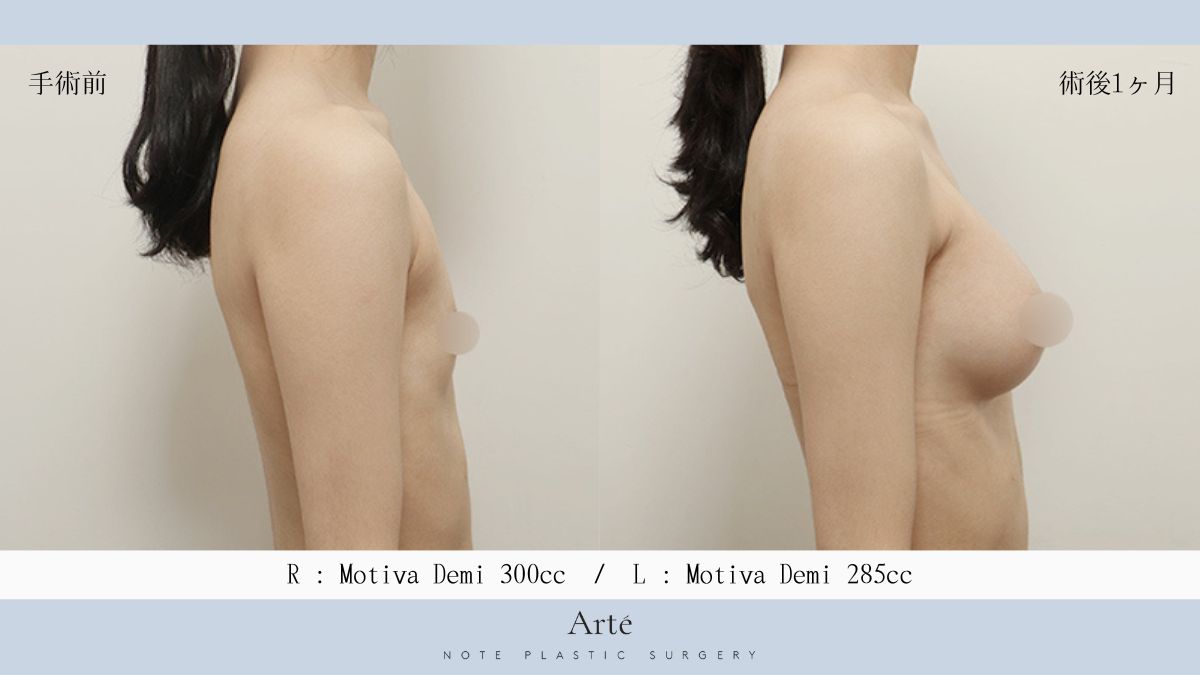 韓国ノート美容外科 豊胸センターArté tweet media