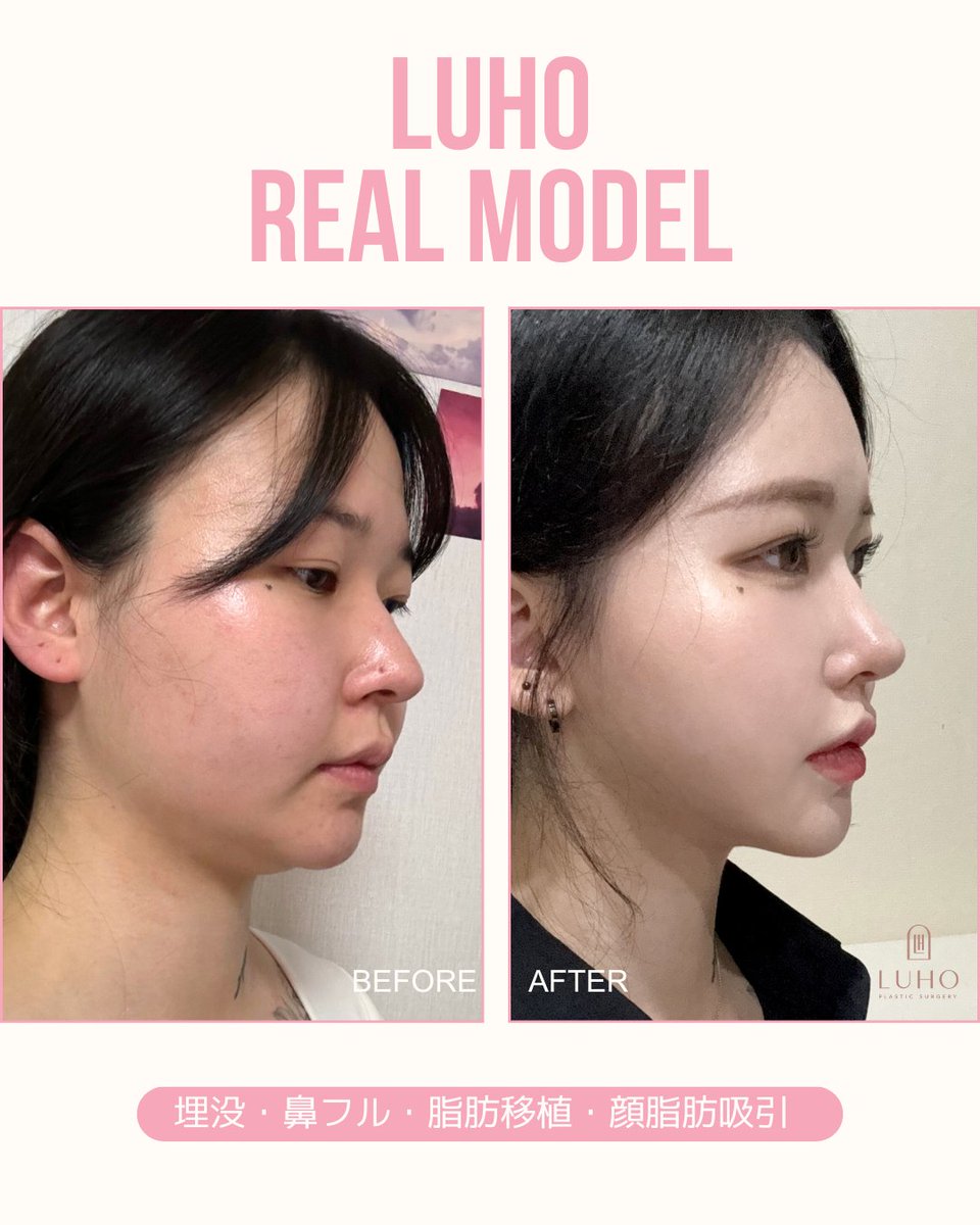 ルホのリアルモデル 💗【Before After💘】 目・鼻・脂肪移植でお顔のトータルバランスを整え 埋没 鼻フル 脂肪移植 顔脂肪吸引 執刀 ...