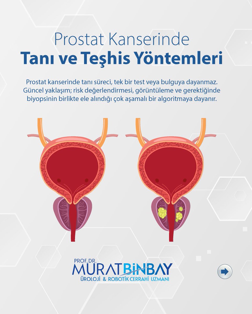 DrMuratBinbay's tweet photo. Prostat kanseri tanısı tek bir testle konmaz.
👉 PSA
👉 Muayene
👉 MR
👉 Gerekirse biyopsi
Hepsi birlikte değerlendirilir.
Doğru tanı = doğru tedavi
#prostatkanseri #üroloji https://t.co/Qga9XukYAs