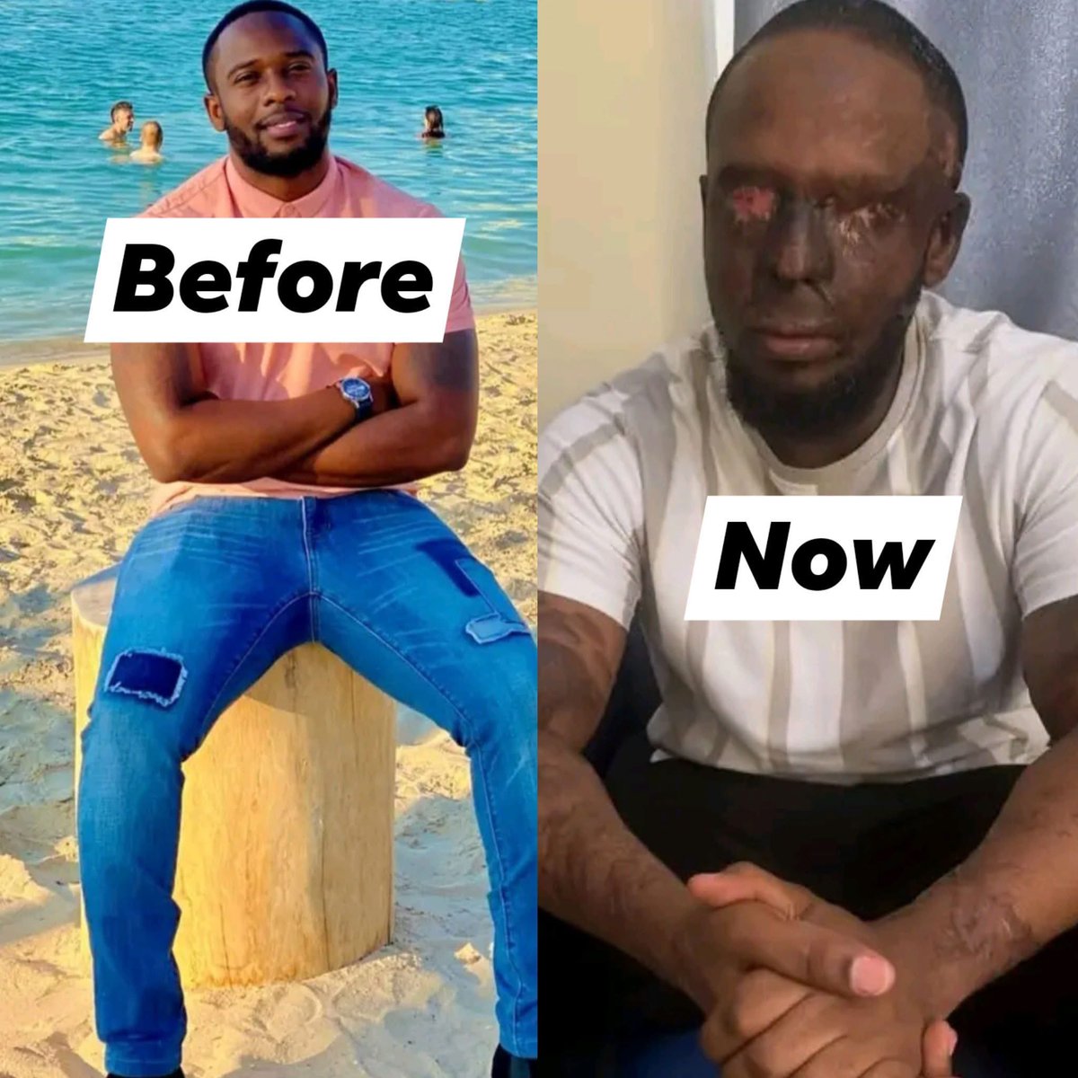 He lost his two eyes 😭 don't push without saying sorry, this is so sad Life can change in a minute He was victim of an acid attack. Two men on a motorcycle allegedly threw acid over him while he was out looking for dinner. 
The attack severely affected his face and body; the