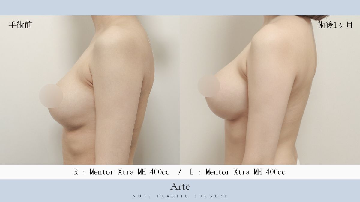 韓国ノート美容外科 豊胸センターArté tweet media