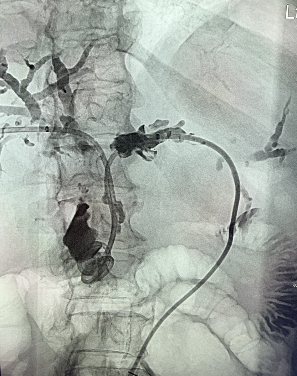AustinBourgeois's tweet image. Bilateral biliary drain for multifocal metastatic disease.  Feels like we're doing this at least once a week now.  Anyone else noticing an increasing frequency  in these over the past several years.  #iRad