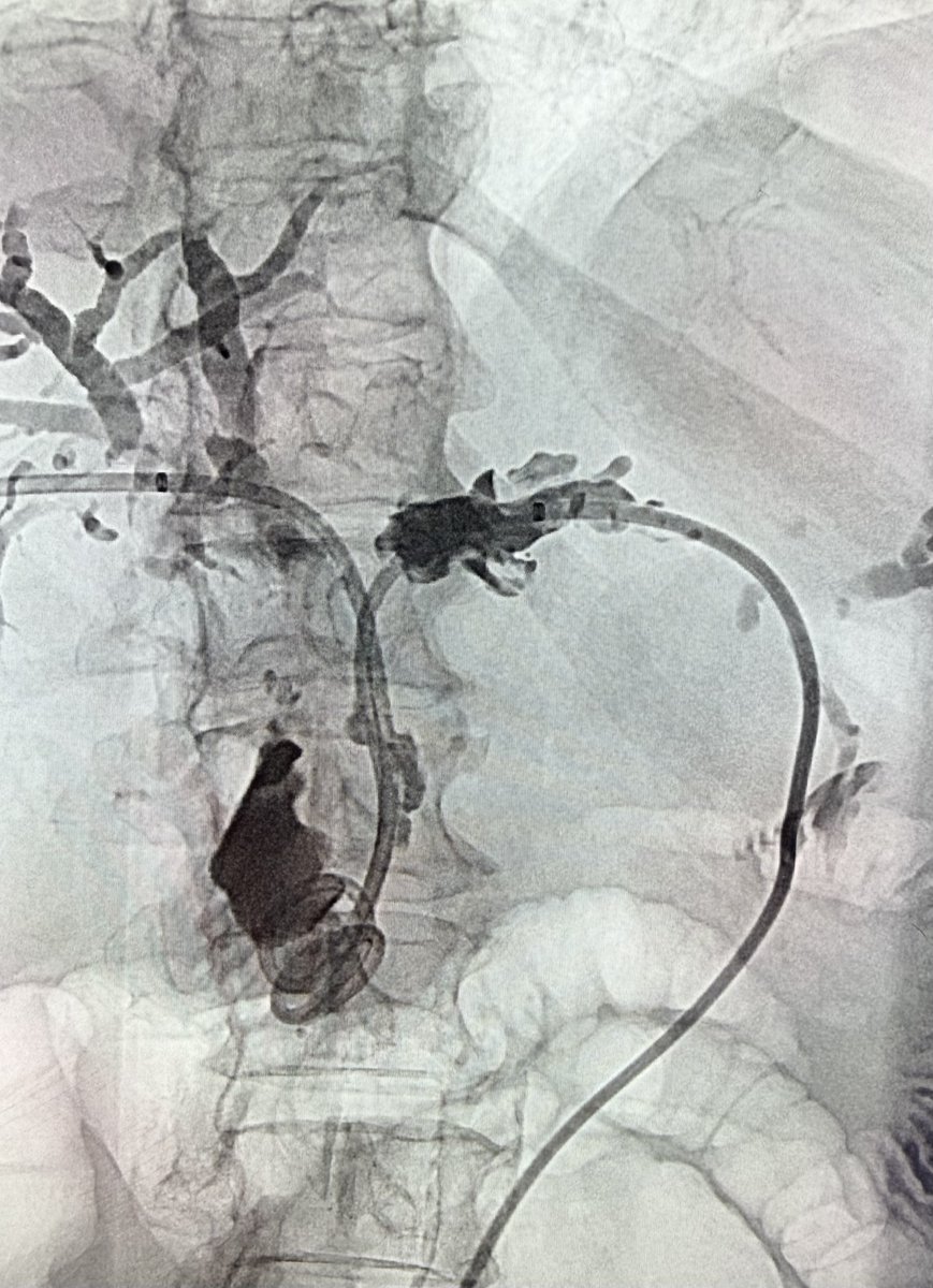 AustinBourgeois's tweet image. Bilateral biliary drain for multifocal metastatic disease.  Feels like we're doing this at least once a week now.  Anyone else noticing an increasing frequency  in these over the past several years.  #iRad