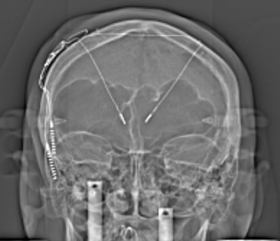 Pediatric Neurosurgery in Atlanta tweet media