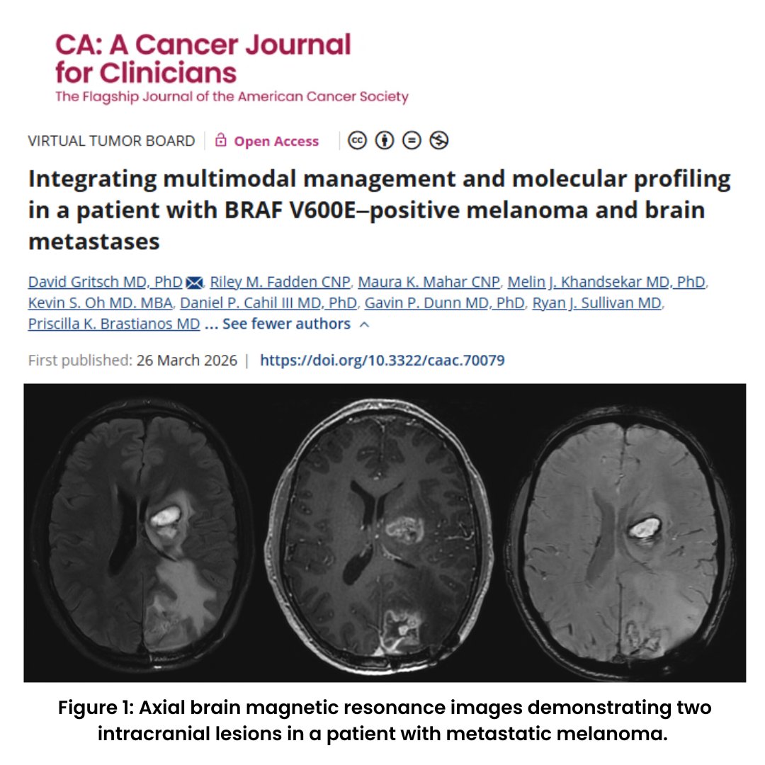 CACancerJournal's tweet photo. New #VirtualTumorBoard from @MassGenBrigham investigators presents a contemporary, practice-focused roadmap for managing melanoma brain metastases (MBMs) in the era of precision oncology.

https://t.co/j8tqgskO4i

@GritschDavid CC: @OncoAlert @KekoaMDPhD https://t.co/3JczmjzZdh