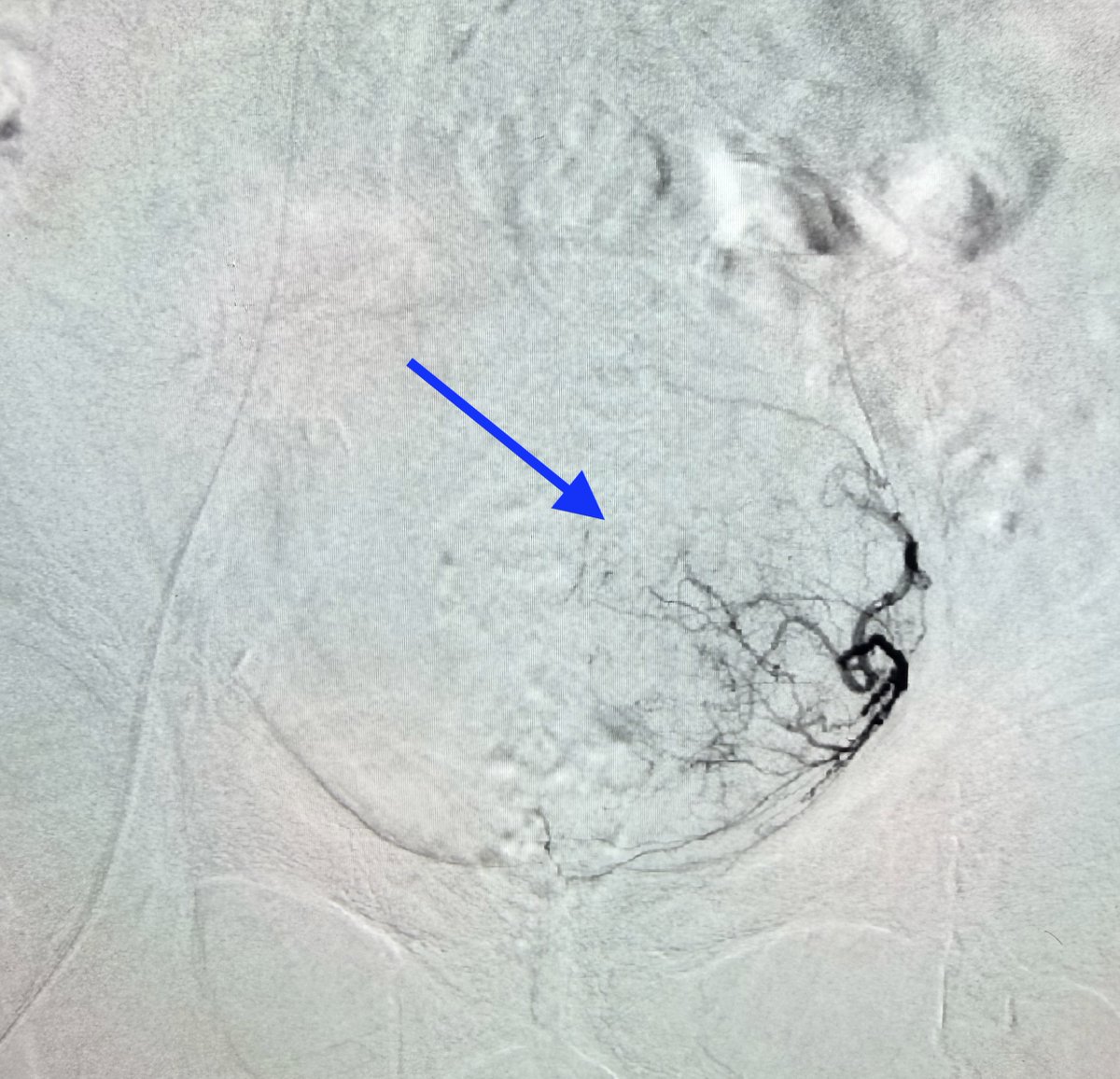 AustinBourgeois's tweet image. Prostatic artery embolization on a really large, 200cc gland.  I am always amazed at how many of these patients have relatively low IPSS scores (&amp;lt;20) in spite of such a large gland.  #PAE #iRad