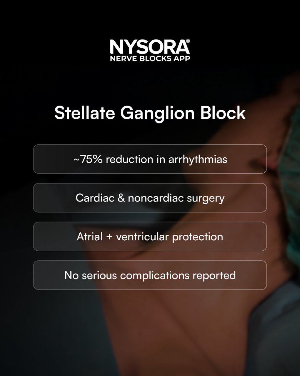 NYSORA's tweet photo. Fragile rhythm before surgery consider neuromodulation. Stellate ganglion block (SGB):
- ~75% ↓ periop arrhythmias
- Benefit in cardiac &amp; noncardiac surgery
- No serious complications reported

Nunez-Rodriguez et al. Br J Anaesth. 2026 Feb;136(2):495-506

https://t.co/whxfXimN4l https://t.co/4IdtROMSsO