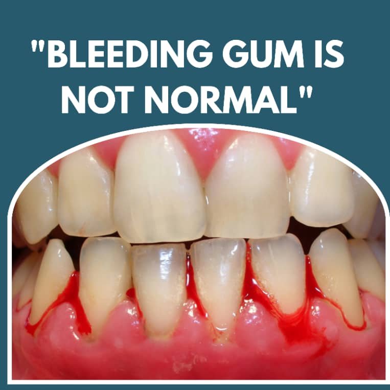 doctorkhali's tweet image. Your mouth is the gateway to your overall health. 🦷
Healthy gums don’t bleed. If they do, it’s your body asking for better care—don’t ignore it.

#OralHealth #HealthyHabits