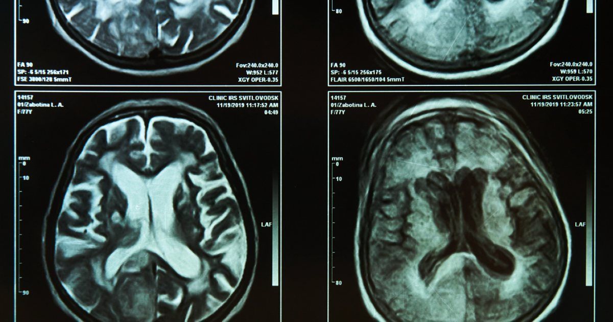 PNS_News's tweet image. A new study tied to Brain Injury Awareness Month finds potential brain injuries in 77% of domestic‑violence cases reviewed in Columbus police reports – often without clear awareness during response or investigation.🎙️buff.ly/pry5Nv3
#BrainInjury #DomesticViolence