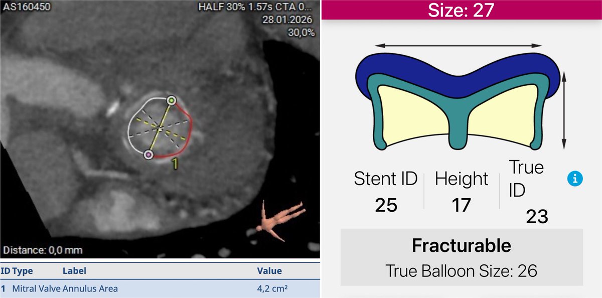 LUnzue's tweet photo. Caso muy del SURViV:
EPIC 27 mitral degenerada en paciente con Trifecta aórtica. 
La app indica Sapien 26 pero consultamos con la experta @MayraGuerreroMD de @MayoClinic 
”fíjate en el área real,ponle una 23+2”. Spoiler: le hicimos caso.. y quedó perfecta!!💪🏻😍😍 https://t.co/SFxHzLC6Dx