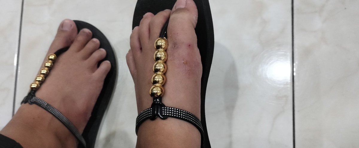 bedazzlinghex_'s tweet photo. @ourdecs @imtheboboo kak aku pernah begitu di kaki, di sela kaki yang paling parah, ku bawa ke dokter spkk dapet salep racikan semingguan udah sembuh total alhamdulilah sampe sekarang udah gak gitu lagi https://t.co/9kOjIgKhGy