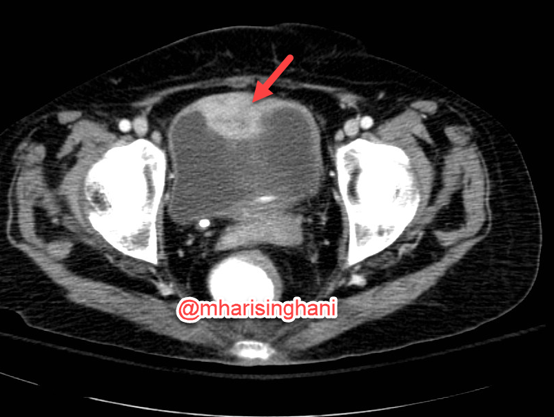 mharisinghani's tweet photo. Not all bladder lesions are urothelial tumors; this was a metastasis https://t.co/dfV5Ka3Eqc