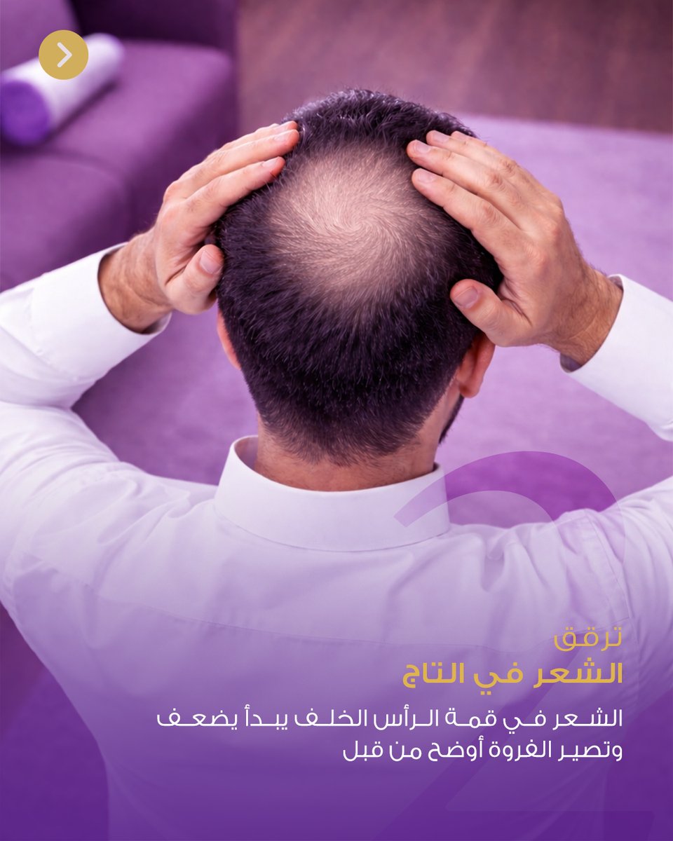 adamacenter's tweet photo. 4 علامات لبداية الصلع ⚠️
• تراجع خط الشعر
• ترقق التاج
• وضوح الفروة
• تساقط ملحوظ
ابدأ بدري قبل ما تتطور الحالة 👌
#تساقط_الشعر #adamacenter #الرياض #حطين #الصلع https://t.co/3Qd0tRg9fS
