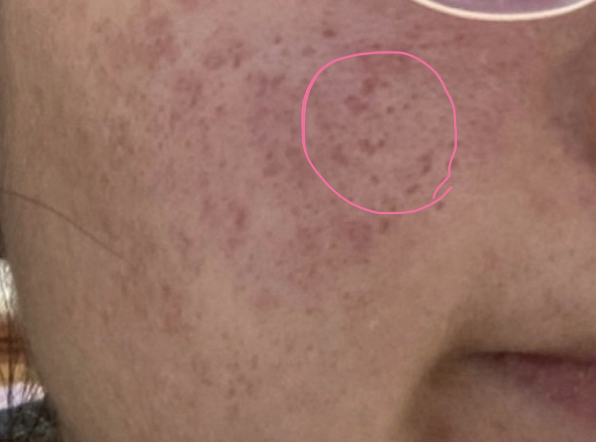 ゆでたまごちゃん🥚｜肌治療オタク　｜クレーター改善記録　｜肌垢さんと繋がりたい tweet media