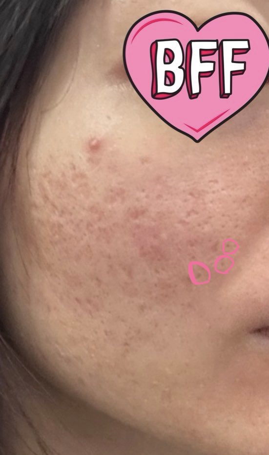 ゆでたまごちゃん🥚｜肌治療オタク　｜クレーター改善記録　｜肌垢さんと繋がりたい tweet media