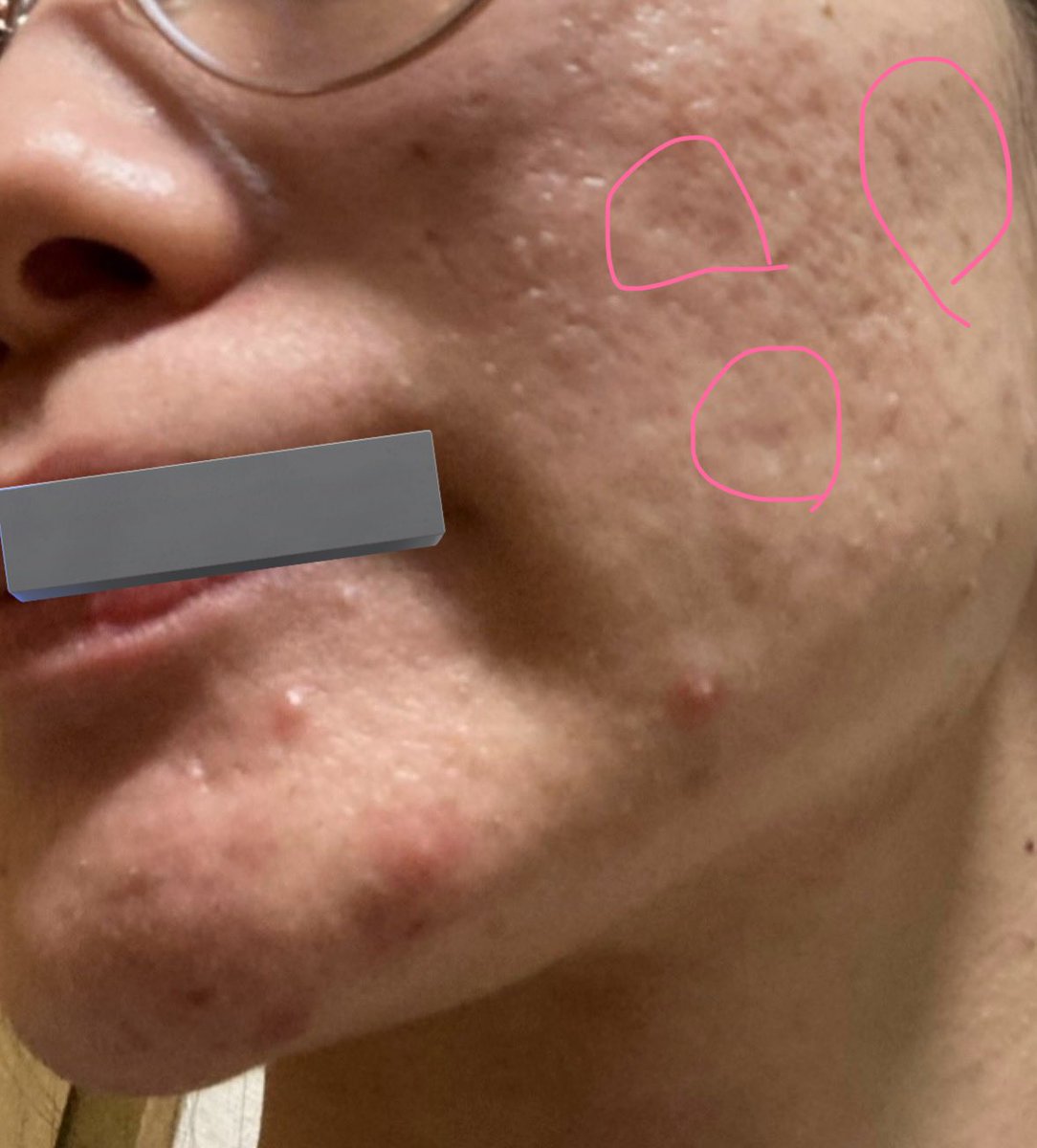 ゆでたまごちゃん🥚｜肌治療オタク　｜クレーター改善記録　｜肌垢さんと繋がりたい tweet media