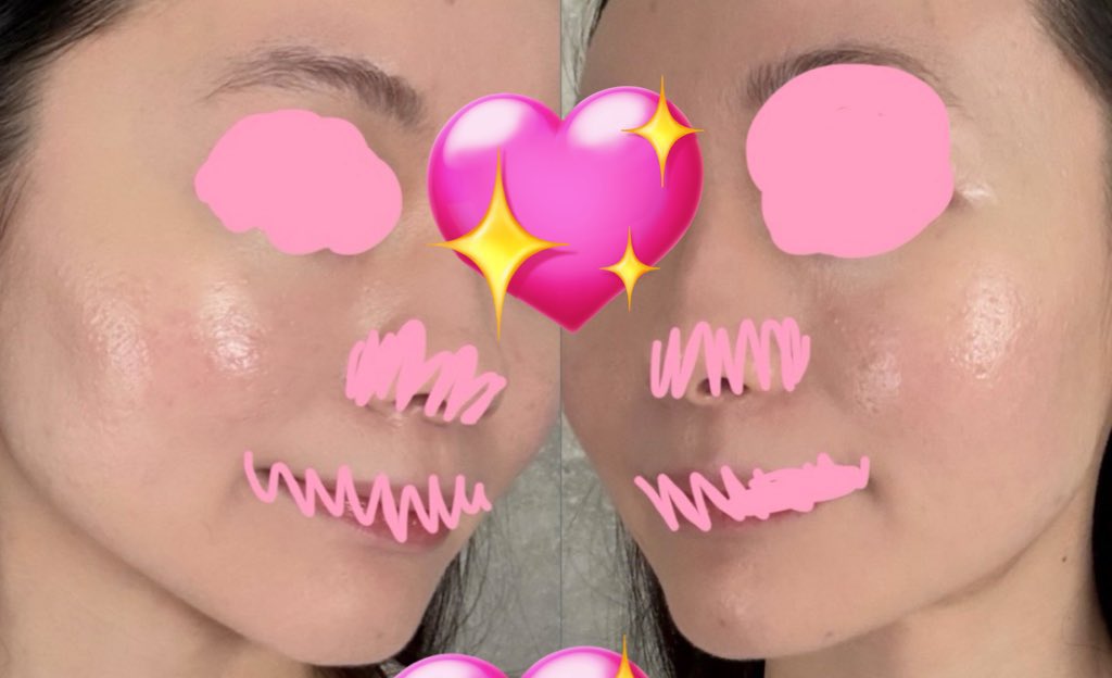 ゆでたまごちゃん🥚｜肌治療オタク　｜クレーター改善記録　｜肌垢さんと繋がりたい tweet media