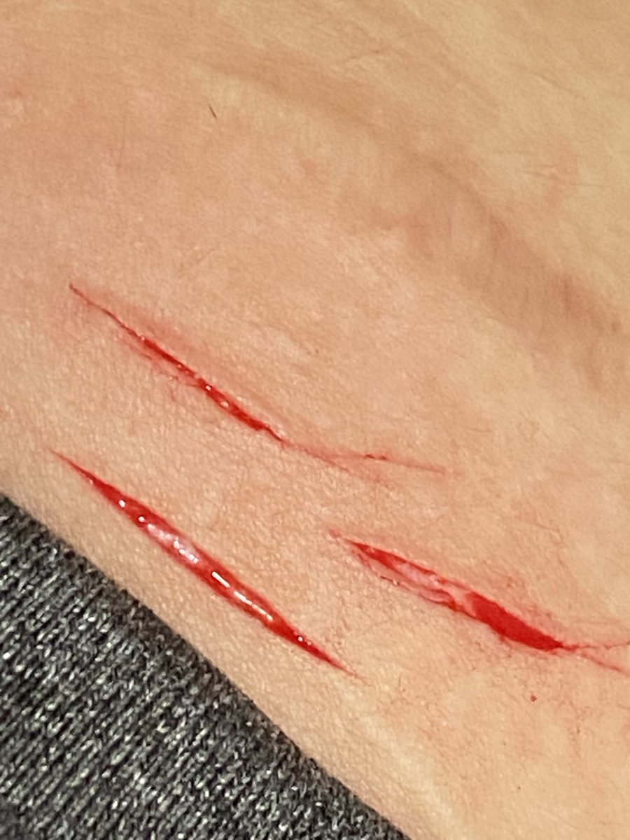 cideerjw's tweet photo. thigh cut // small sesh, doesn't count as a relapse.. right? 😖

#shtwt #sh https://t.co/mfuCvyS1tv