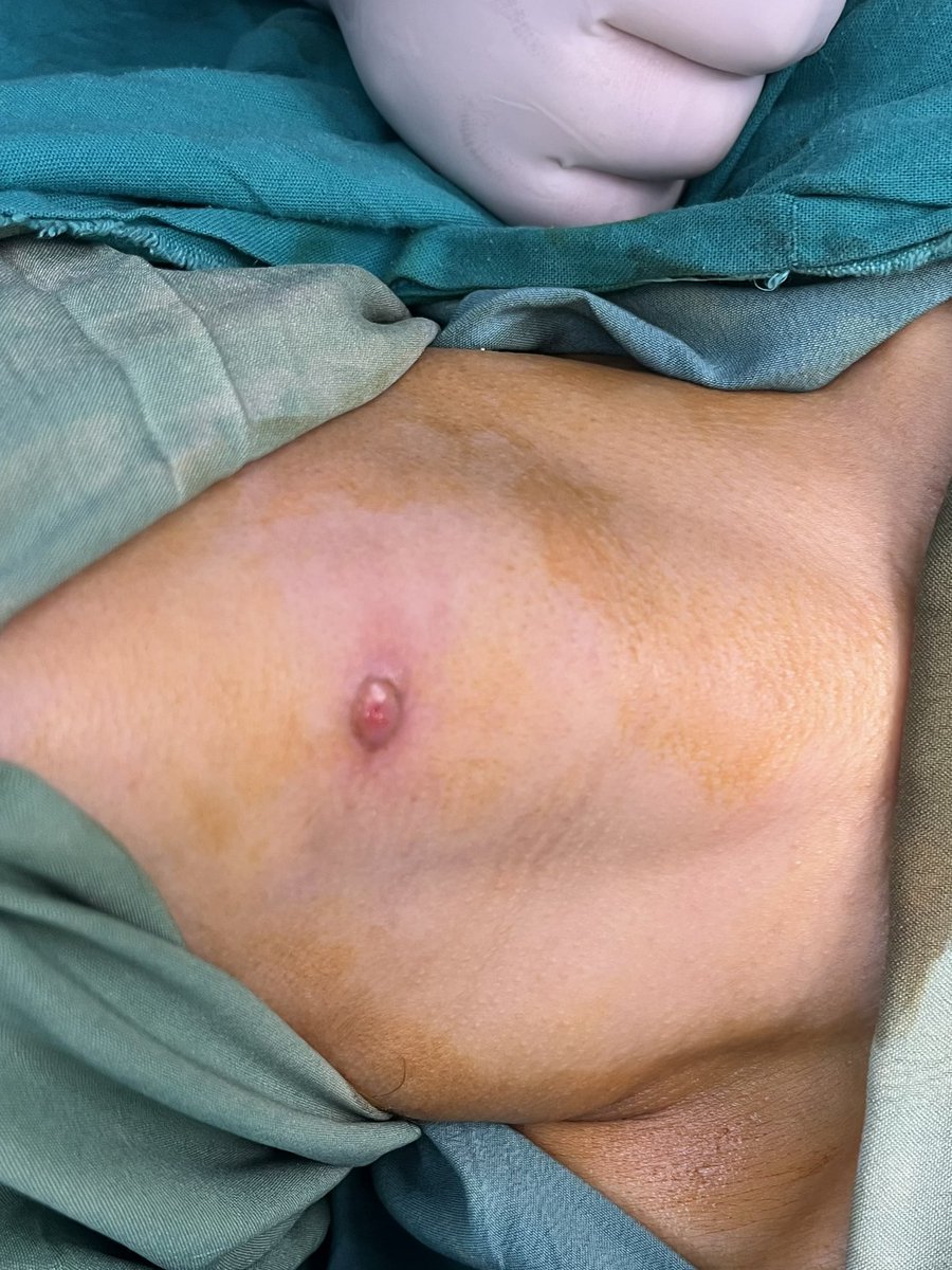 osamahn19's tweet photo. My case today of thyroglossal sinus excision through sistrunk operation https://t.co/p0JqBeo0wh