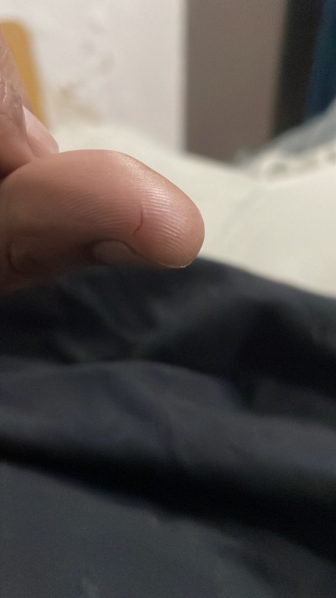 conclus1onn's tweet photo. @Swiggy FIX YOUR PACKAGING! This is the second papercut this month. The paper bag edges are literal blades. https://t.co/3WotdUZmQz