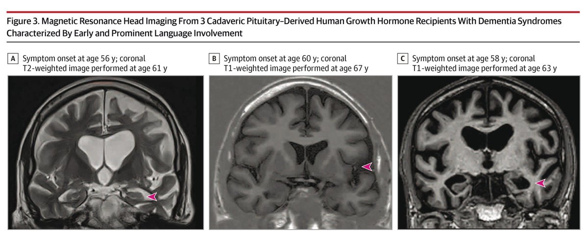 Durante años, la hormona de crecimiento derivada de hipófisis de cadáveres fue un recurso terapéutico legítimo, incluso esperanzador. Nadie sospechaba que, junto con el impulso al crecimiento, pudiera viajar algo más silencioso y profundamente inquietante: fragmentos de una