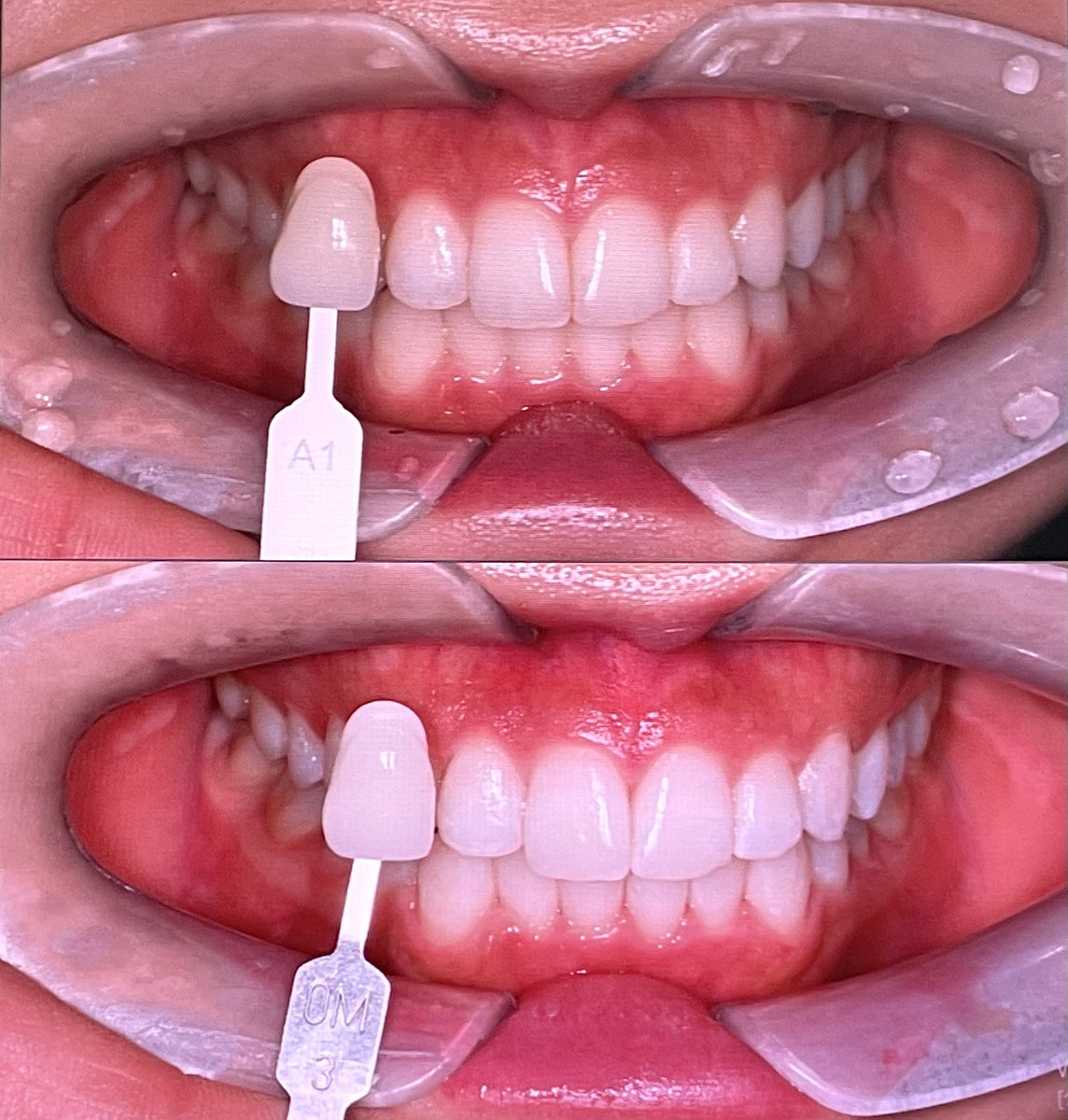 ごりちゃん脂肪豊胸DT🇰🇷5/28-6/2 tweet media