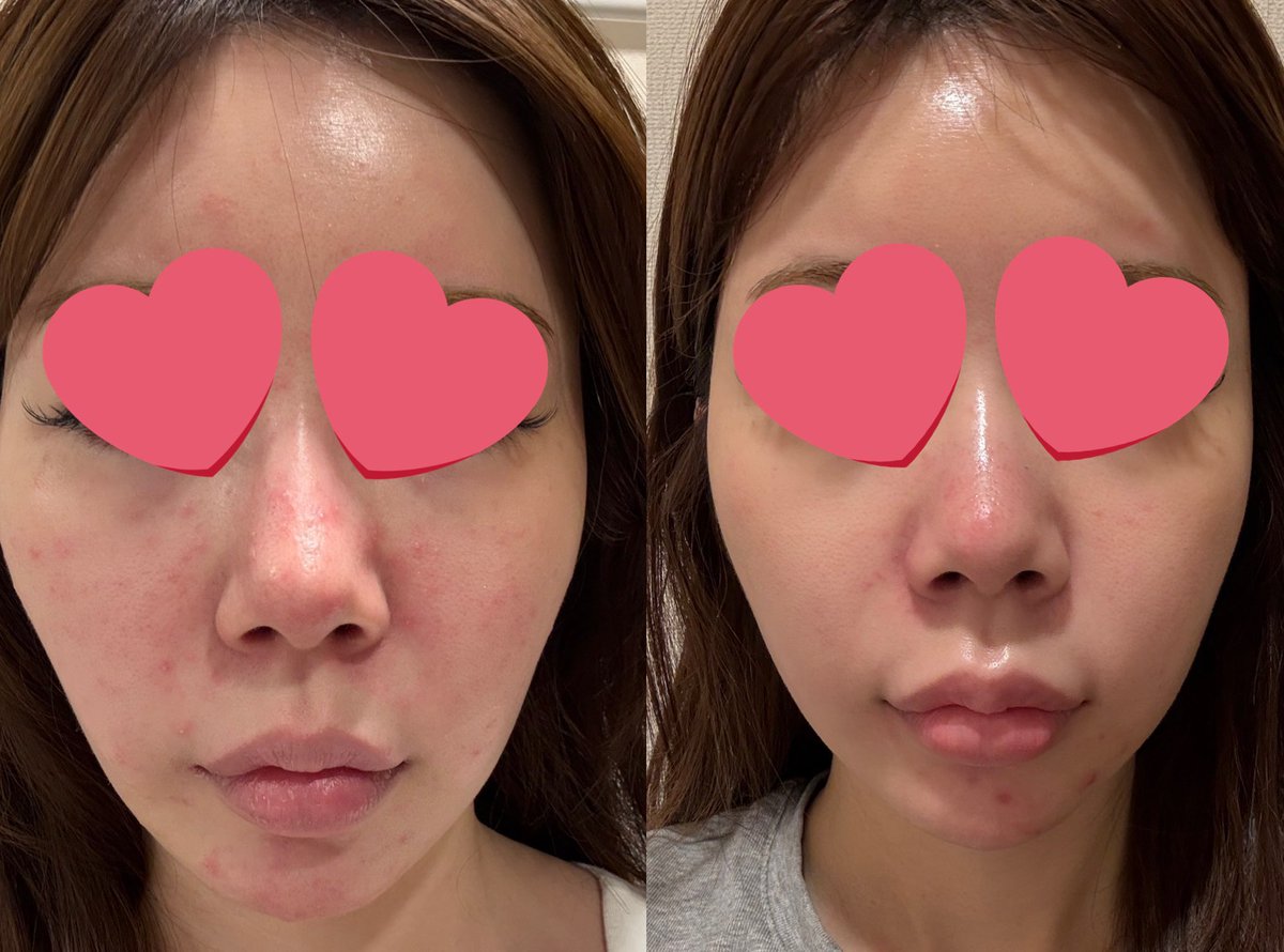 わさ美@赤み肌改善×美容医療 tweet media