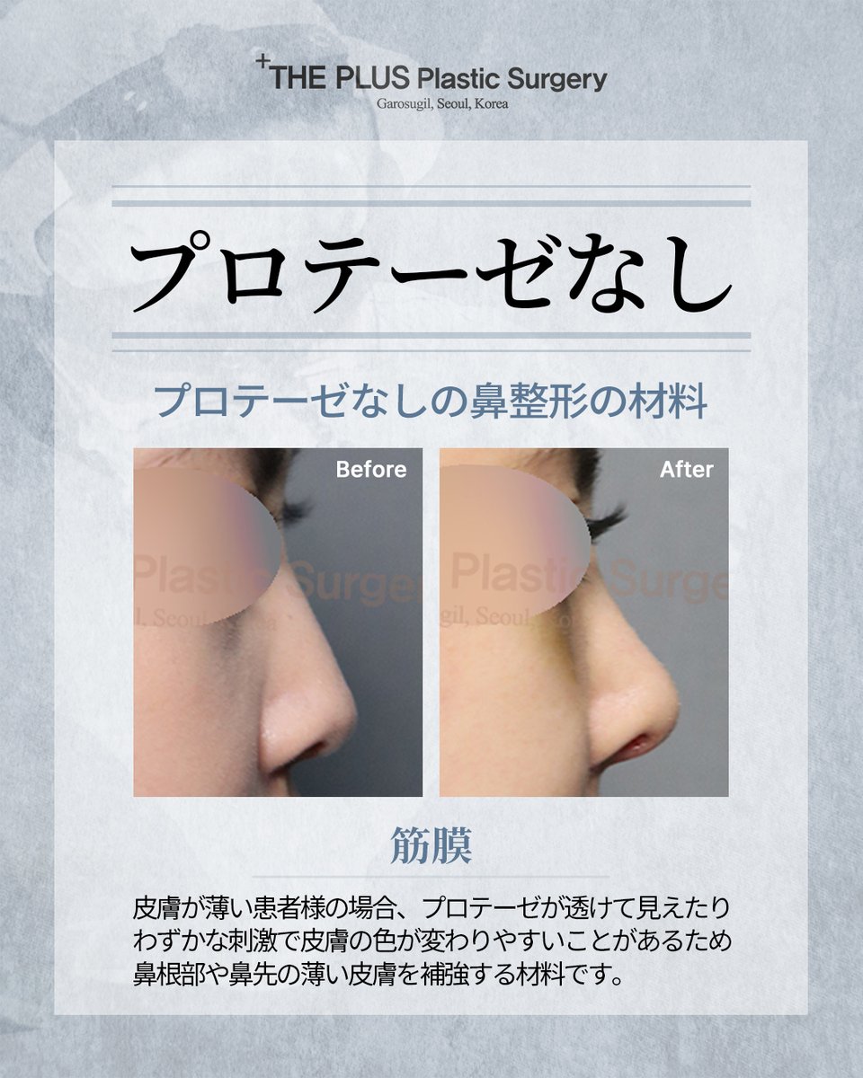 theplusjapan's tweet photo. #ザプラス韓国本院

👃プロテーゼを使用しない鼻整形

シリコン等のプロテーゼを使用せず、耳介軟骨や鼻中隔軟骨などの自家組織で自然な高さを出す手術です。

アレルギーや感染リスクが低く、身体に馴染みやすいのが特徴で、ナチュラルな仕上がりを期待できます✨

💌: @ https://t.co/eIPd8KufGy https://t.co/nbPENuPb57