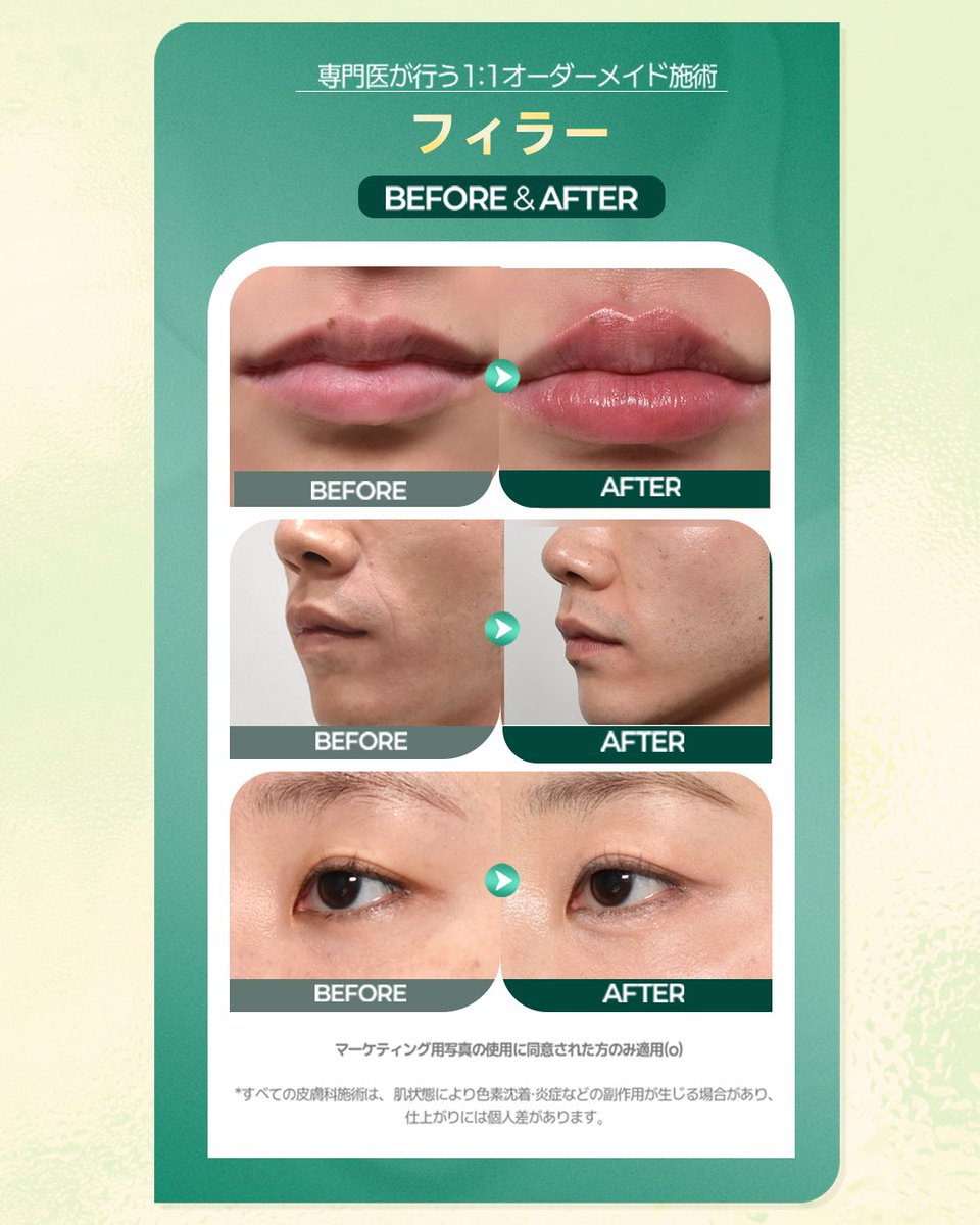 【韓国美容】ベンジャミンクリニック tweet media