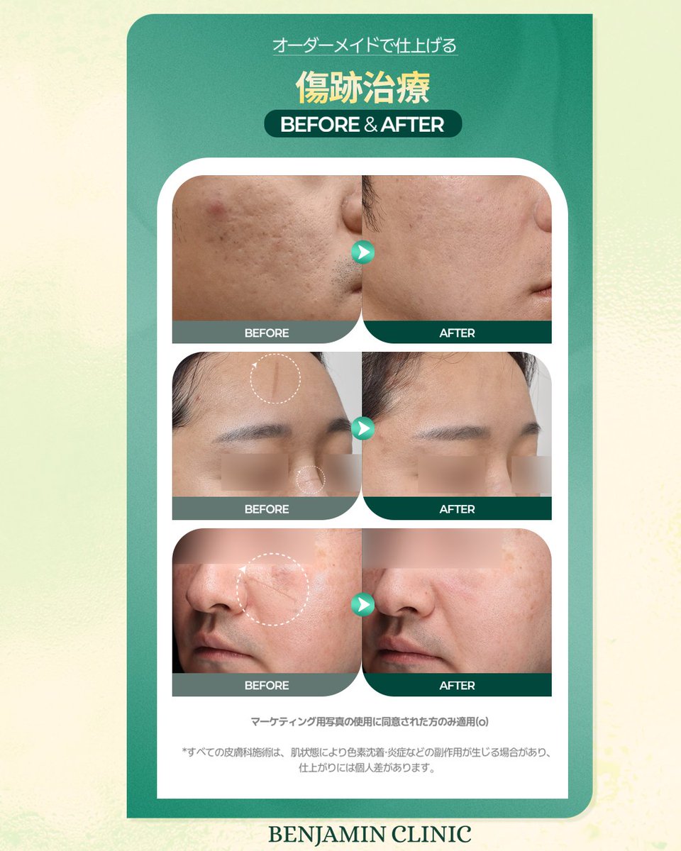 【韓国美容】ベンジャミンクリニック tweet media