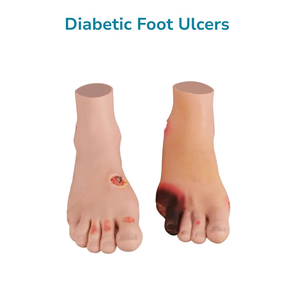 Full-Foot Diabetic Foot Ulcer Model - Mild & Severe Stages