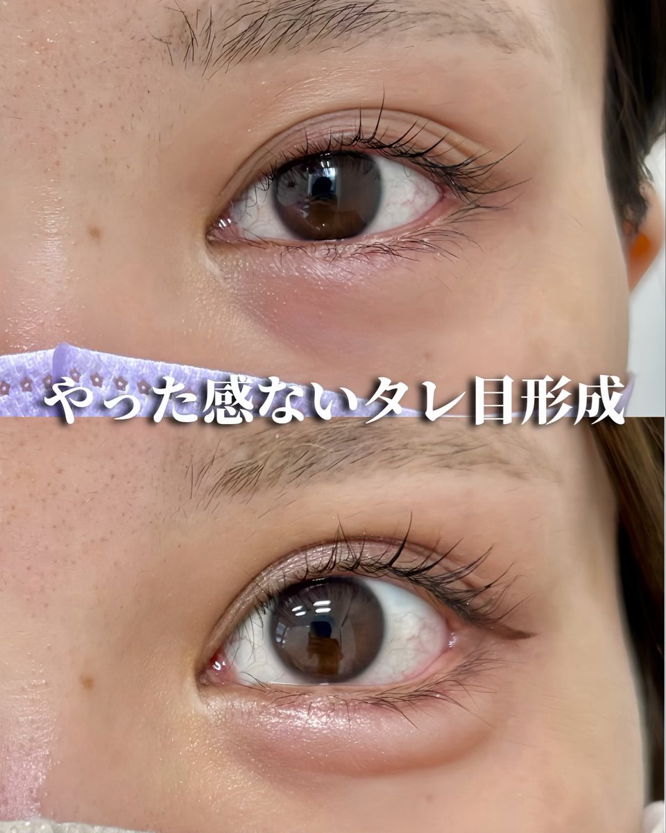 dr_toyokawa's tweet photo. 【タレ目形成、目尻切開は大阪で！！】
タレ目形成(グラマラスライン形成)は非常に難易度が高く、タレ目形成を専門にしているドクターは少ないです。関西在住の方で目を大きくしたい方は僕にお任せください！アナザークリニック大阪梅田院でお待ちしてます✨
#タレ目形成#グラマラスライン形成#目尻切開