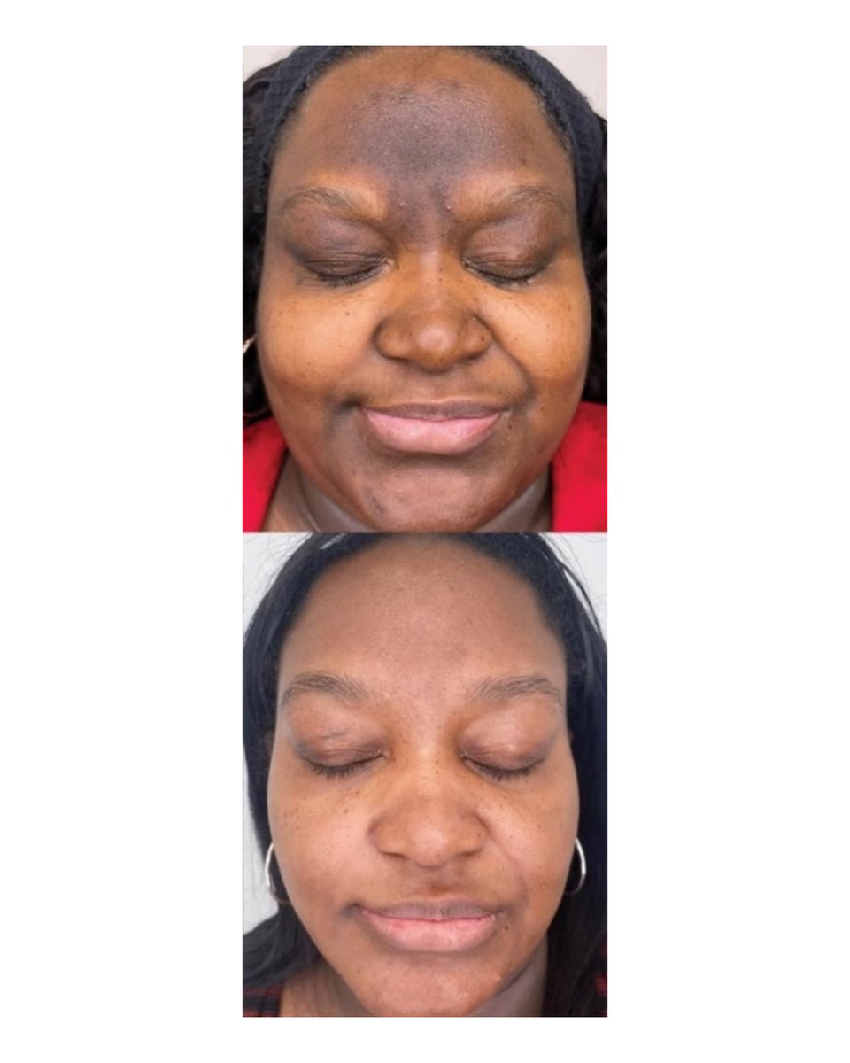 NoFilterSkin's tweet image. Start your skincare journey.
If you've started, stay consistent. 

#BeforeAndAfter