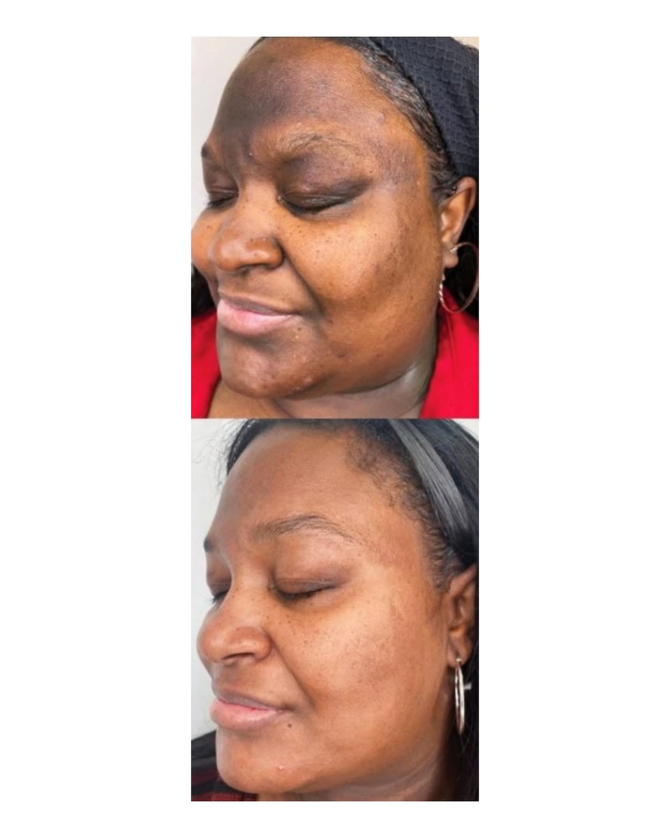 NoFilterSkin's tweet image. Start your skincare journey.
If you've started, stay consistent. 

#BeforeAndAfter