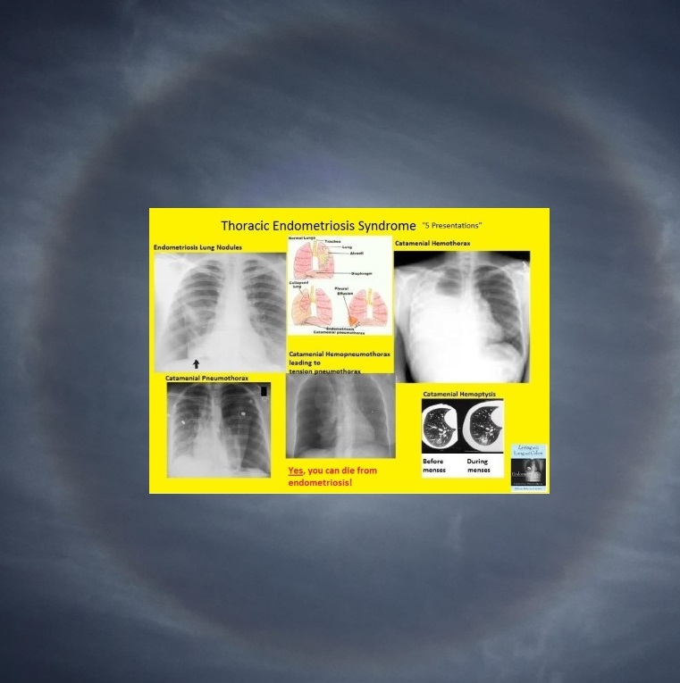 GlynDMD's tweet photo. It is the last day of #Endometriosis Awareness Month, and a new level has been reached. Cardiothoracic has stepped up to discuss Thoracic Endometriosis. Thank you. All forms of endometriosis are serious and can be deadly. Loss of oxygen due to Thoracic can quickly lead to mental impairment or death when endometrial nodules become catamenial. I am aware and extremely grateful that without God's mercy, my life would be very different. I have had every presentation and survived.