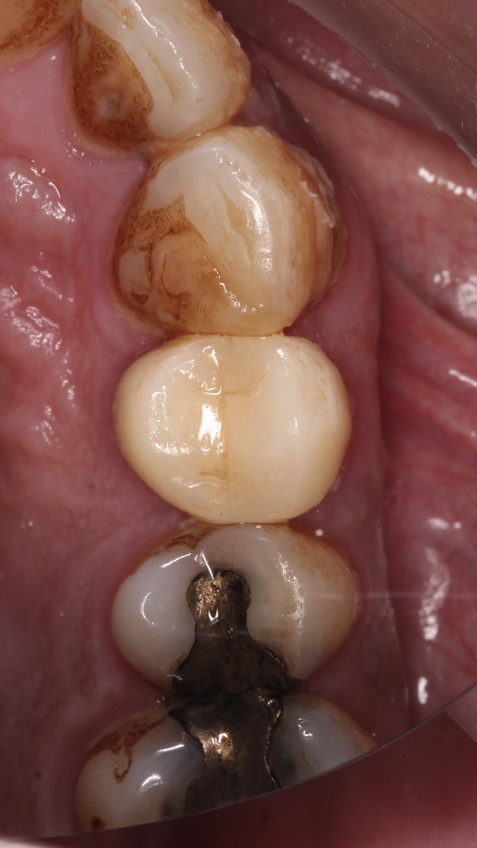 DentRetaj's tweet photo. The story from badly destructive tooth, to fully functioning and aesthetic one🪄🪄 https://t.co/CWNeb71CaD