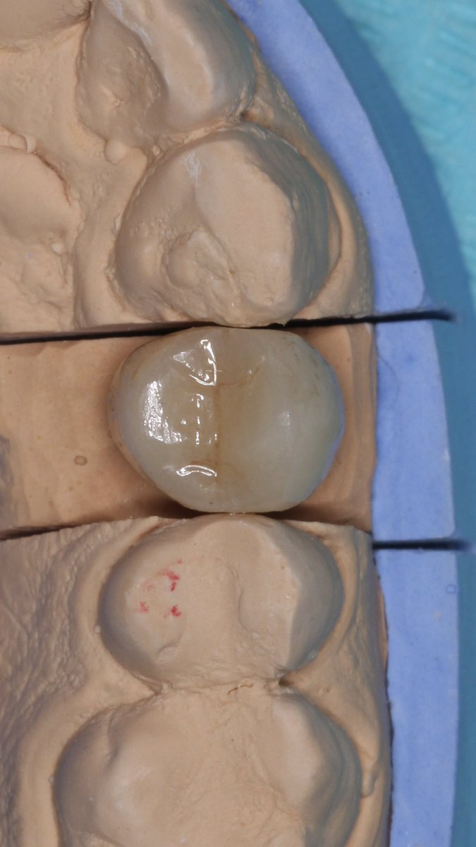 DentRetaj's tweet photo. The story from badly destructive tooth, to fully functioning and aesthetic one🪄🪄 https://t.co/CWNeb71CaD